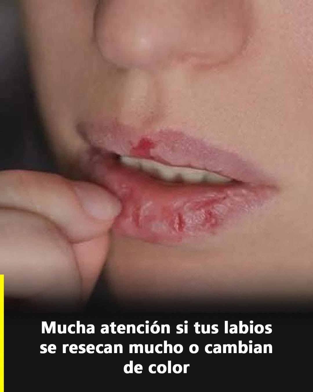 Labios agrietados y resecos