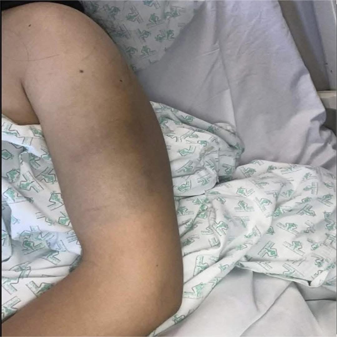 Hematoma en brazo