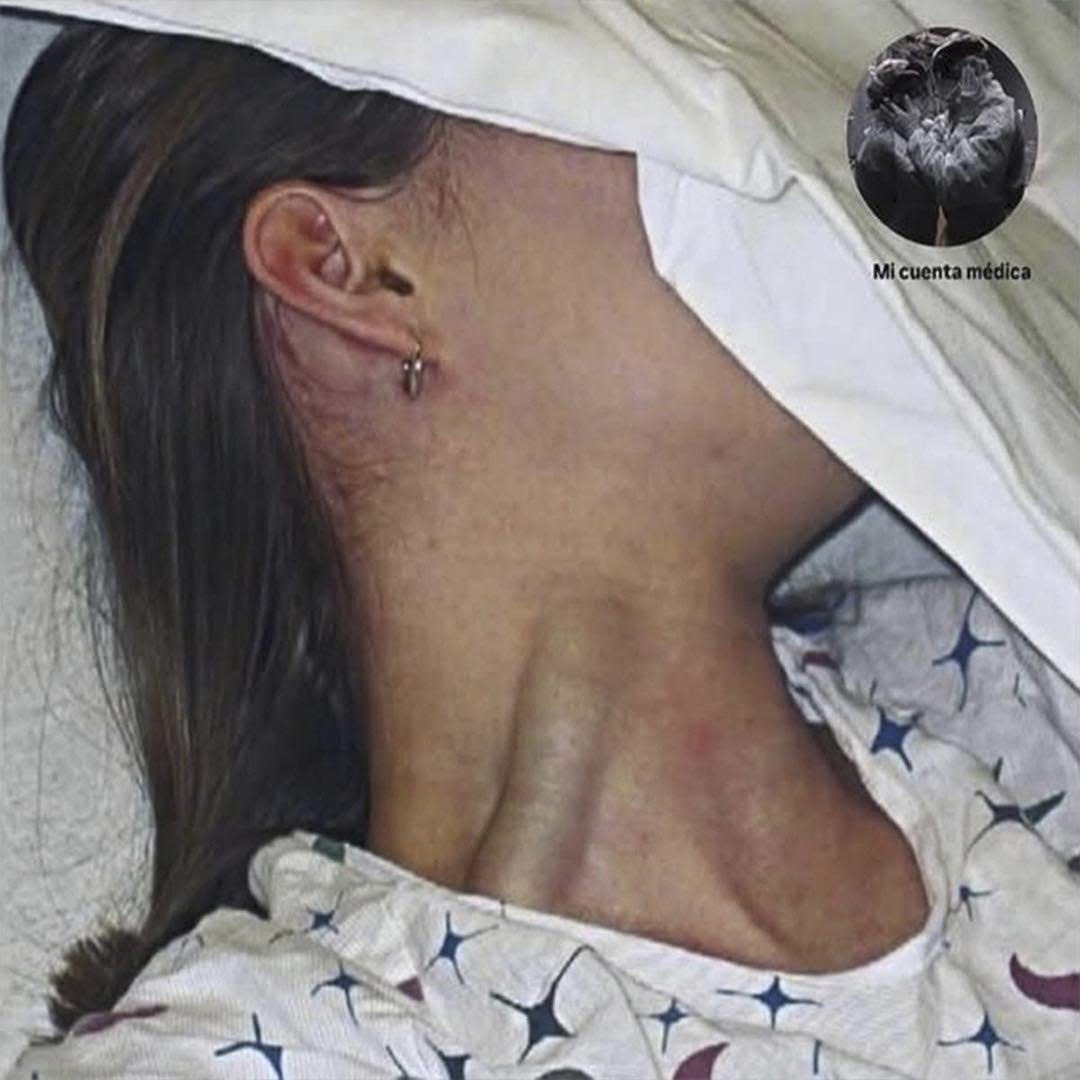 Distensión yugular masiva en un entorno hospitalario