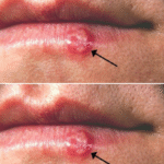 ¡Atención! Señales de Tu Cuerpo: Lesiones en los Labios y Remedios Naturales