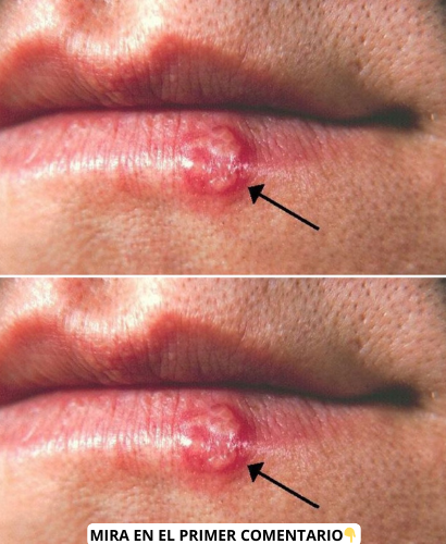 Lesión cutánea en labio por herpes labial