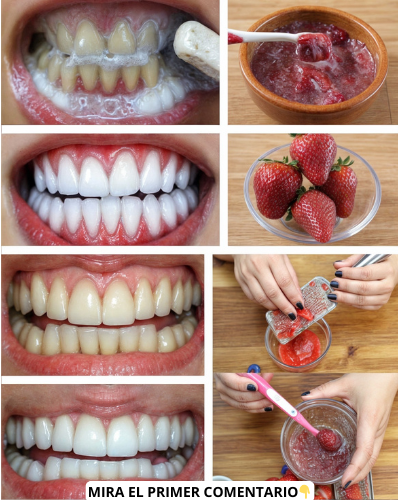 Proceso de blanqueamiento dental con fresas