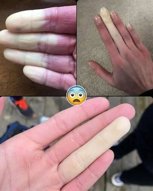 Manos con síntomas de fenómeno de Raynaud
