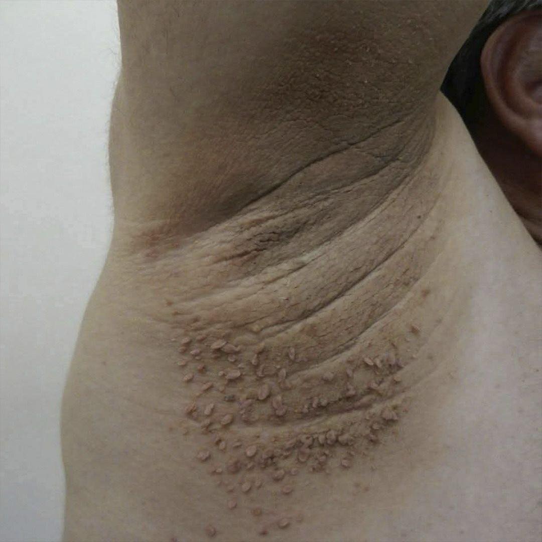 Prototipos de condiciones dermatológicas en axilas