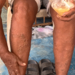 El Cura Pie: El Remedio Natural que Combate la Artritis