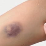 Moretones Sin Golpes: Razones y Remedios Naturales