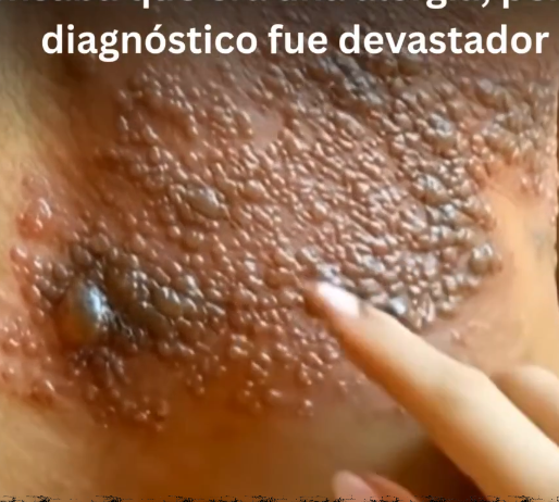 Remedios caseros para la Culebrilla