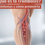 Todo lo que Necesitas Saber sobre la Trombosis: Síntomas, Causas y Remedios Naturales