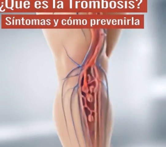 Trombosis: prevención y síntomas