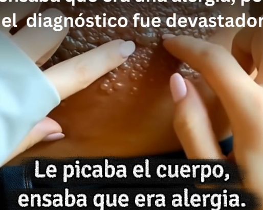 Remedios caseros para la culebrilla