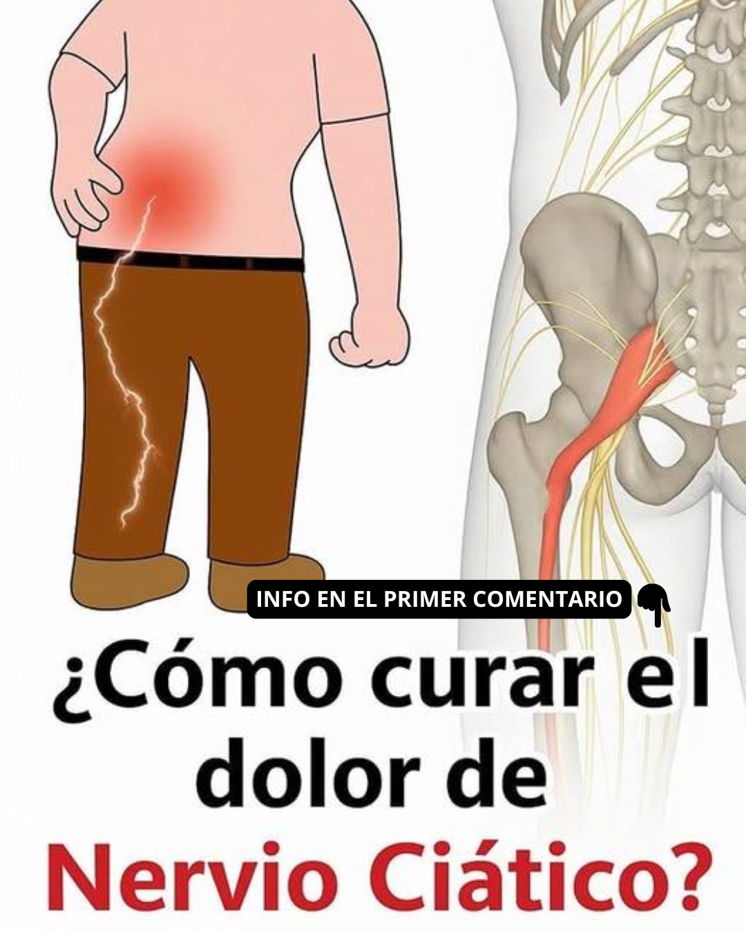 Dolor ciático