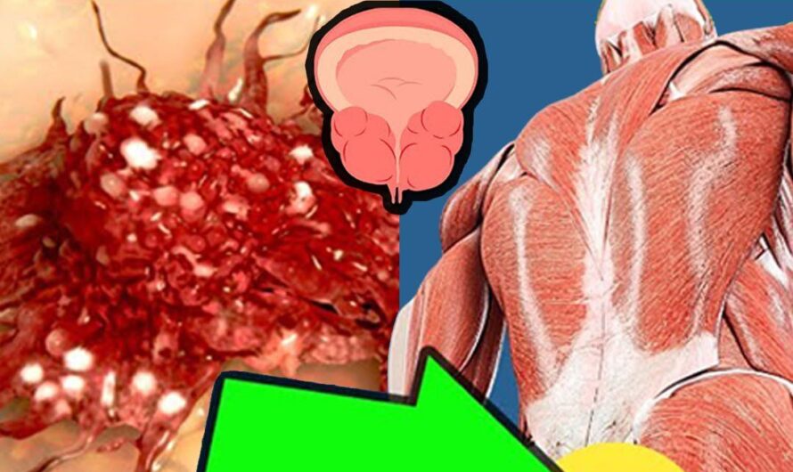 Cáncer de Próstata: Primeros Signos y Síntomas ¡No lo Ignores!