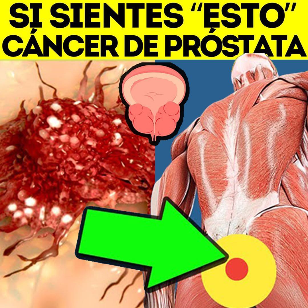Cáncer de Próstata