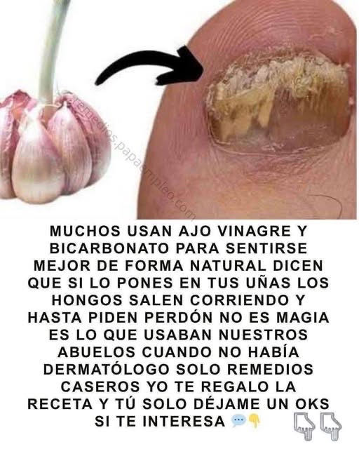 Remedios naturales para hongos en las uñas