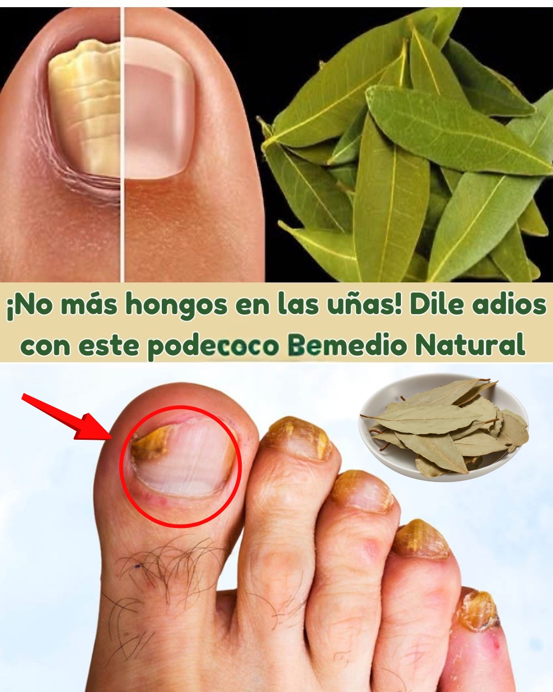 Remedio natural para hongos en las uñas