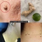 Elimina Verrugas de Manera Natural: Remedios Caseros Efectivos
