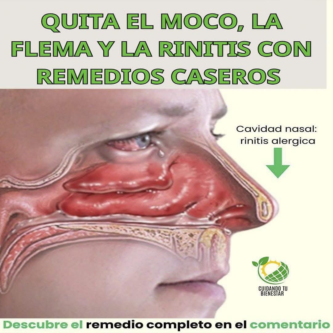 Remedios Caseros para la Rinitis
