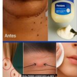 Remedio Casero con Vaselina para las Verrugas: Tu Guía Práctica