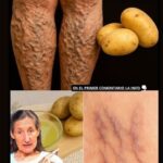 Diga Adiós a las Várices y a las Piernas Pesadas con Este Método Natural – 100% Efectivo