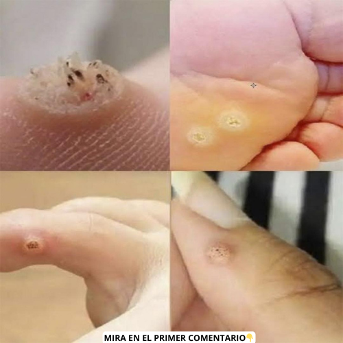 Diferentes tipos de verrugas en manos y pies