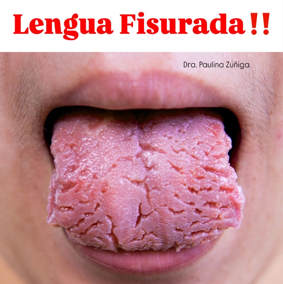 Lengua fisurada