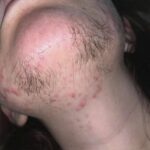 Vello en la Barbilla de la Mujer: Causas Principales, Síntomas y Formas Efectivas de Tratarlo