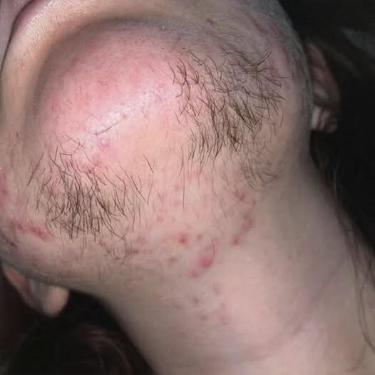 Vello en la Barbilla de la Mujer: Causas Principales, Síntomas y Formas Efectivas de Tratarlo