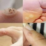 Verrugas en la piel: Causas, tratamiento y remedios naturales