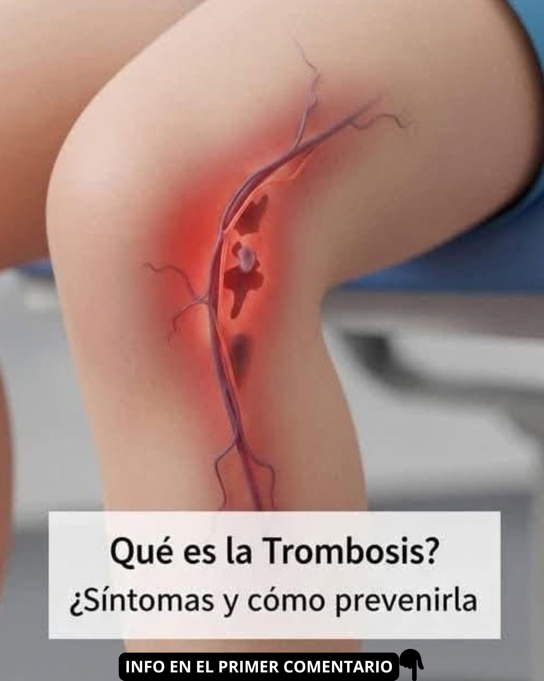 Representación de una trombosis en una pierna