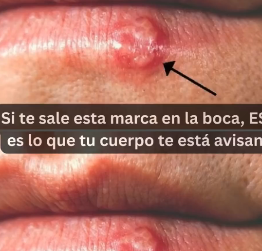 Remedios naturales para Aftas y Herpes Bucales