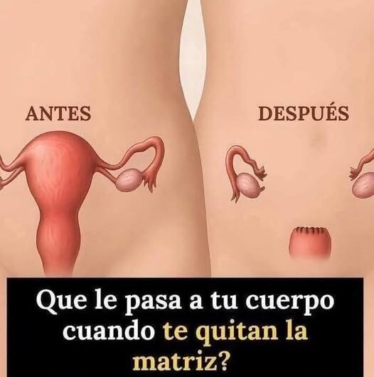 Lo que debes saber sobre los efectos de una histerectomía en tu cuerpo