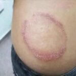 Infecciones en la piel: qué sabes — y lo que no debes ignorar