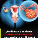 Síndrome de ovario poliquístico: lo que realmente significa tener “quistes en los ovarios”