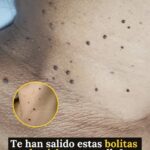 ¿Qué son esas bolitas que salen en el cuello y por qué aparecen?