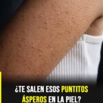 ¿Tienes puntitos ásperos en la piel? Lo que realmente los causa y cómo mejorar su apariencia.