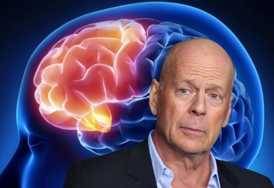Bruce Willis: el diagnóstico que puso atención sobre la demencia frontotemporal