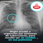Mujer acudió a urgencias por síntomas de tuberculosis, pero resulto ser un condón