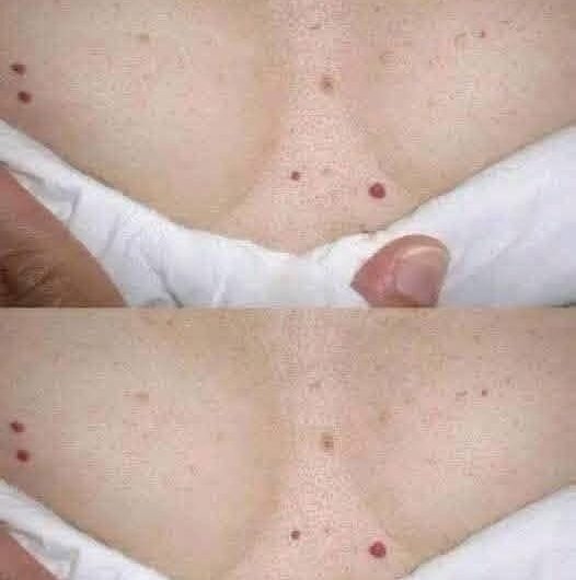 Puntos rojos en la piel: cuándo son inofensivos y cuándo podrían indicar un problema de salud