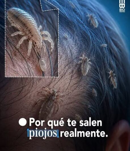 Piojos en la Cabeza: Por Qué Aparecen, Cómo se Contagian y Qué Hacer para Eliminarlos