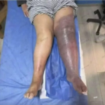 Inflamación en una sola pierna: señales de alerta que no deberían pasarse por alto