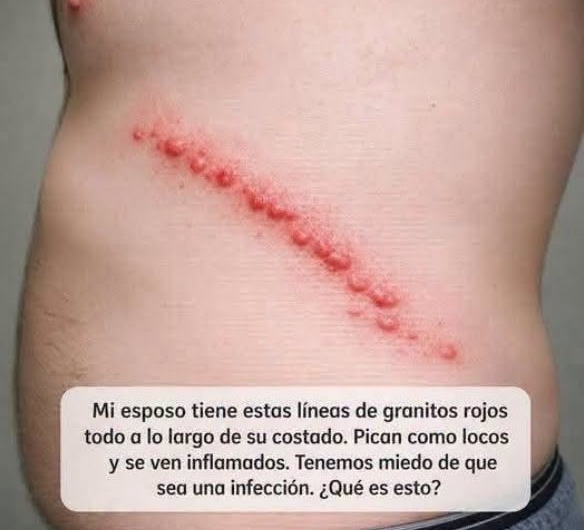 Bultitos Rojos en un Costado del Cuerpo: Posibles Causas, Señales de Alerta y Cuándo Consultar
