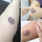 Moratones en el cuerpo sin golpe: causas comunes, señales de alerta y cuándo consultar