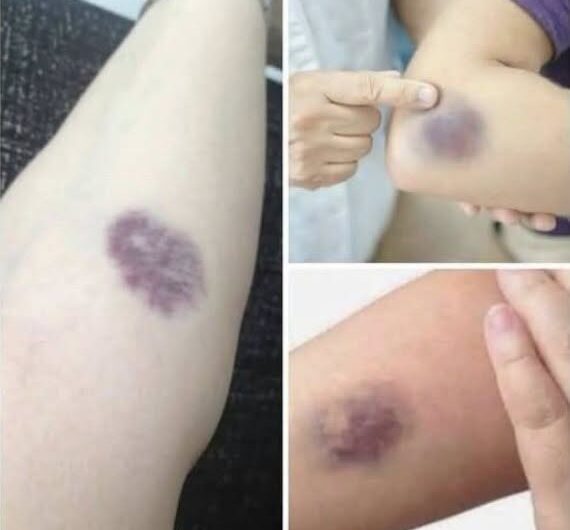 Moratones en el cuerpo sin golpe: causas comunes, señales de alerta y cuándo consultar