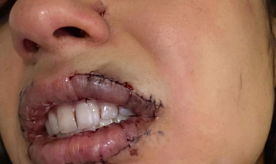 Mujer escapa con los labios cosidos y pide ayuda en Japón: qué ocurrió y cómo avanza el caso