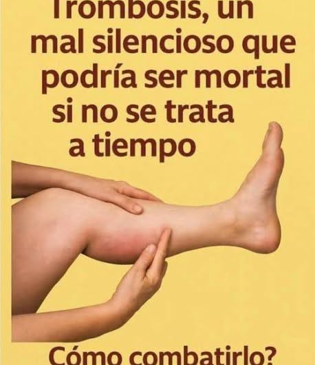 Trombosis: señales de alerta, prevención segura y por qué no debes confiar solo en remedios naturales