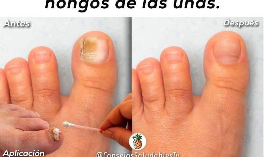 Hongos en las uñas y callos en los pies: qué funciona de verdad y qué remedios evitar