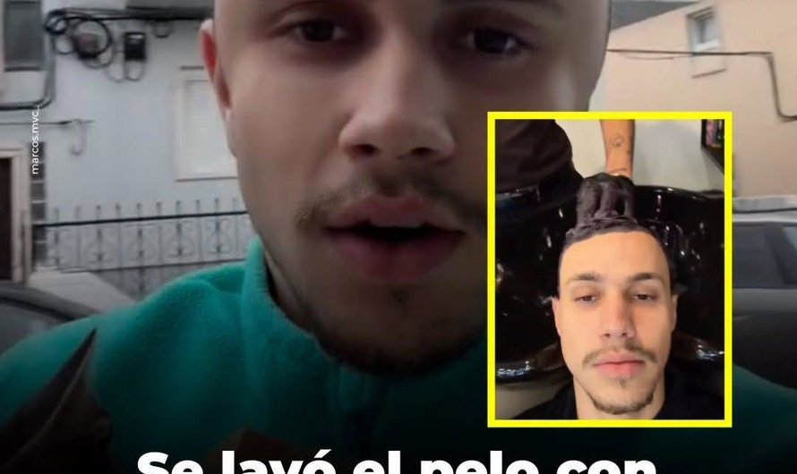 Reacción alérgica al tinte de cabello: por qué puede hinchar la cabeza y cuándo es una emergencia