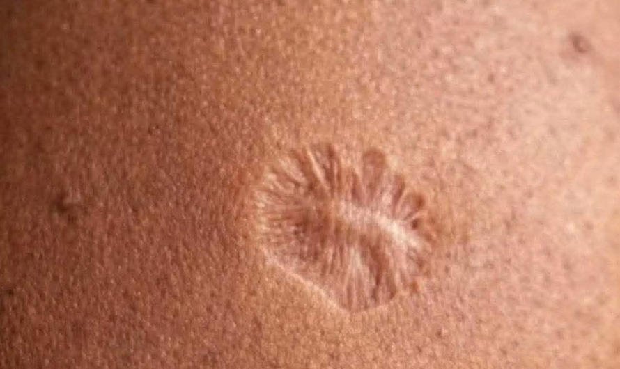 Por qué algunas vacunas dejaron una marca en el brazo: la explicación científica