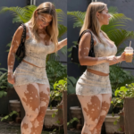 Vitiligo: por qué aparece, si es contagioso y cómo enfrentar el rechazo por las manchas en la piel