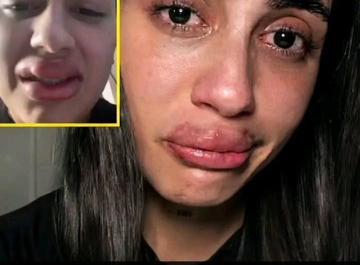 Joven denuncia que le inyectaron silicona con aceite industrial en los labios: qué ocurrió y cuáles son los riesgos
